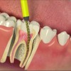 Лечение корневых каналов - Шингарева врач стоматолог, Новоуральск, зубнойболи.net, стоматолог и я