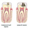 Лечение кариеса - Шингарева врач стоматолог, Новоуральск, зубнойболи.net, стоматолог и я