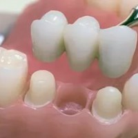 Протезирование несъемное - Шингарева врач стоматолог, Новоуральск, зубнойболи.net, стоматолог и я
