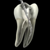 Лечение корневых каналов - Шингарева врач стоматолог, Новоуральск, зубнойболи.net, стоматолог и я
